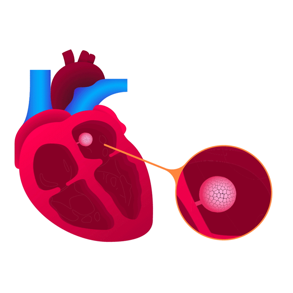 Myxoma Surgery